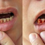 what-does-gum-disease-look-like